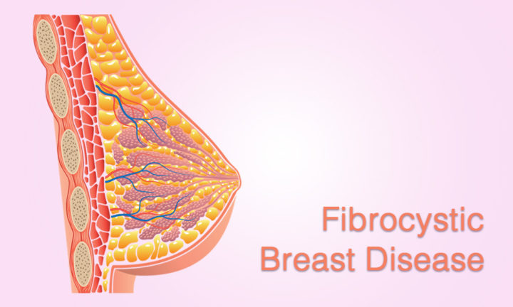 Fibrocystic Breast Disease is Common - HopeHealth